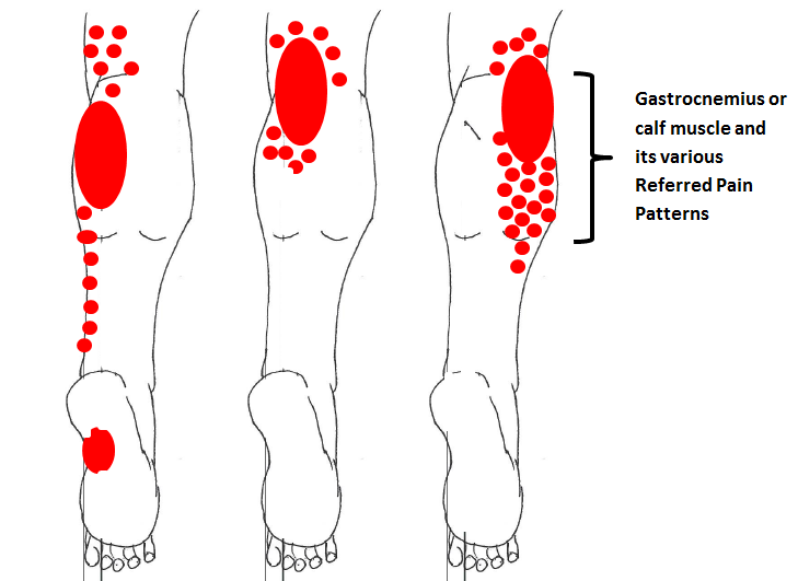 gastroc trigger points gastroc trigger points